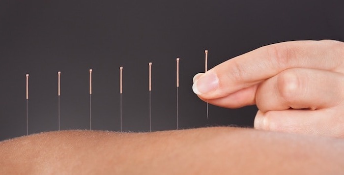L’acupuncture pour accompagner le patient en phase terminale